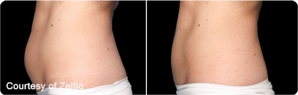 CoolSculpting before and after images.
