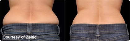 CoolSculpting patient results.