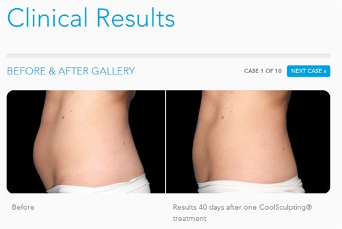 CoolSculpting before and after gallery