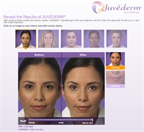 Juvederm Visualizer